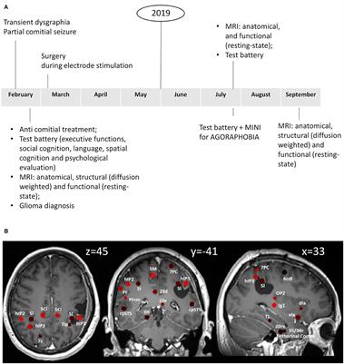 A case report of agoraphobia following right parietal lobe surgery: changes in functional and structural connectivities of the multimodal vestibular network